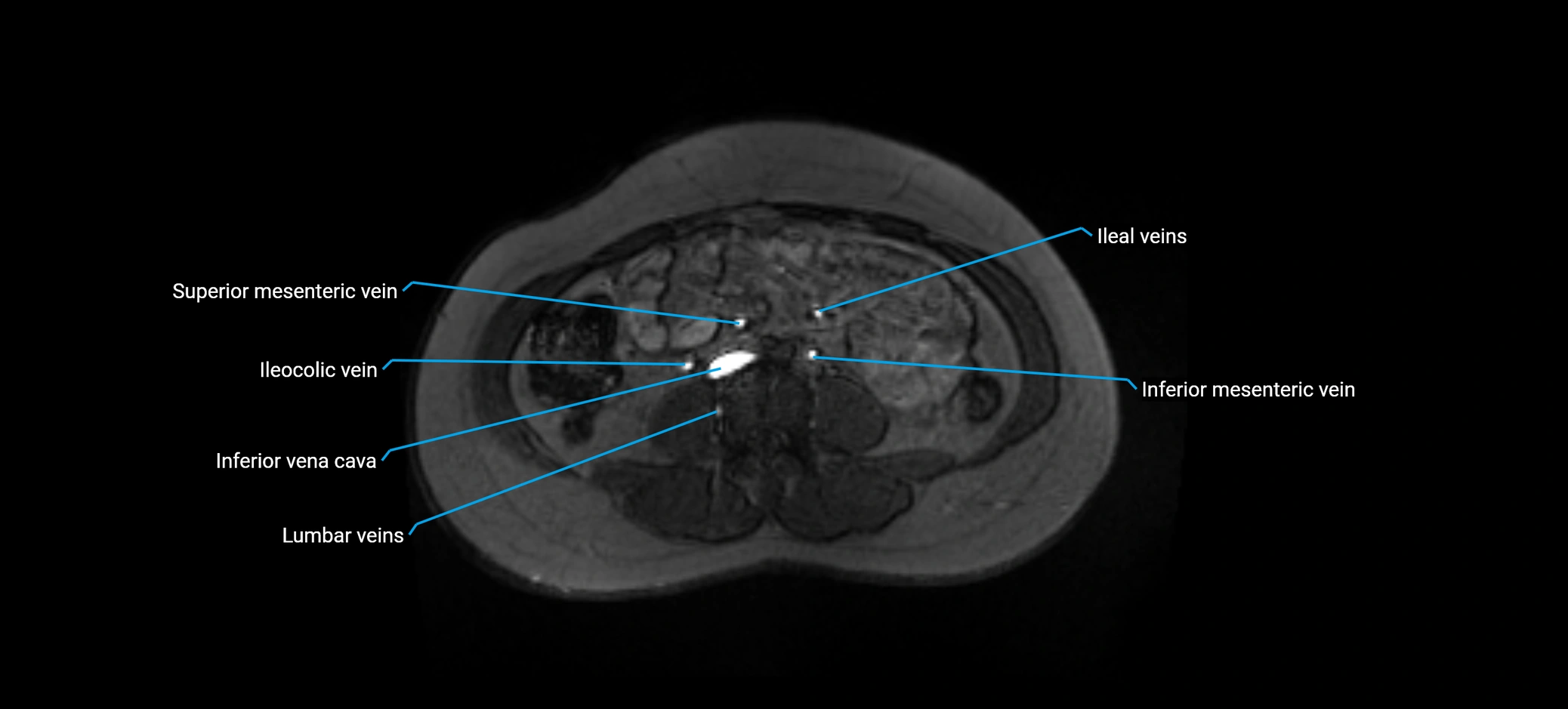 MRV abdomen pelvis & lower limb axial cross sectional anatomy labelled MRI image 104 (1).webp